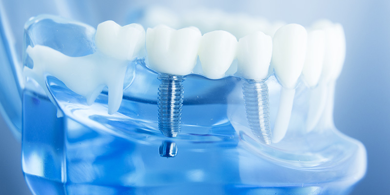 インプラントとは