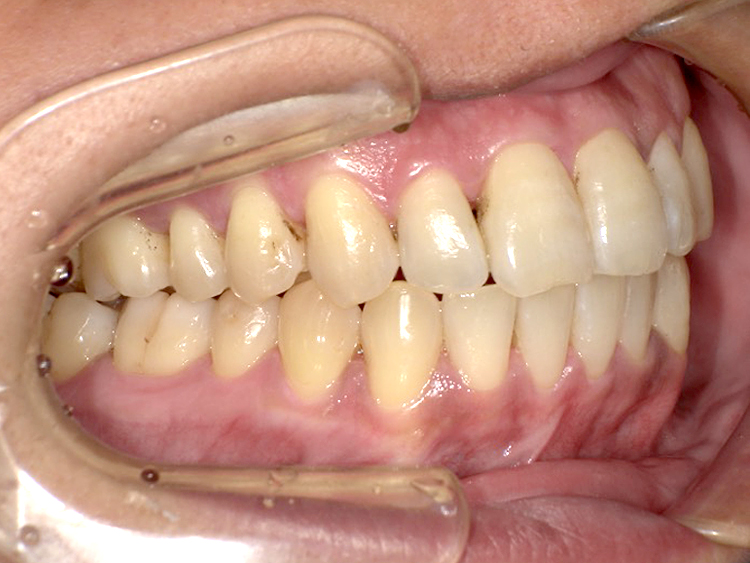 インビザラインの症例