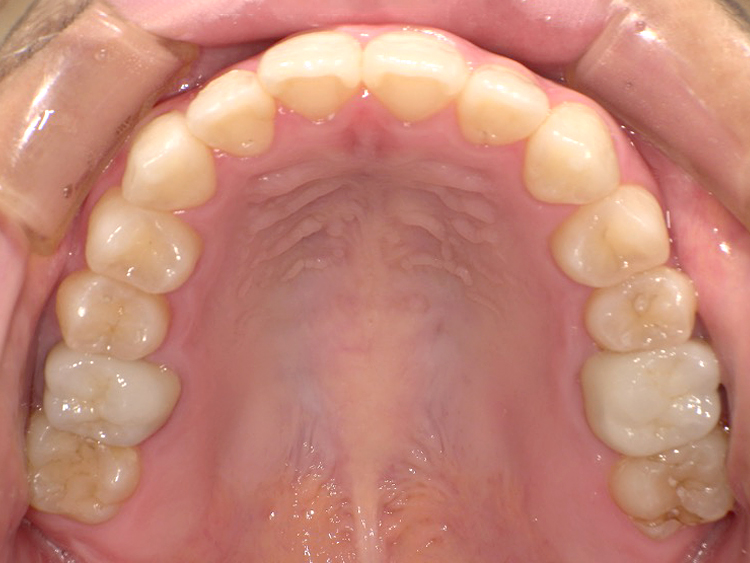 インビザラインの症例