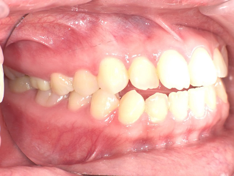 インビザラインの症例