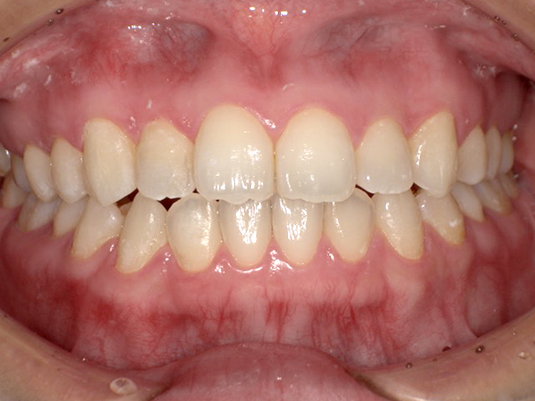 インビザラインの症例