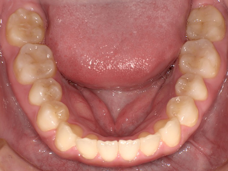 インビザラインの症例