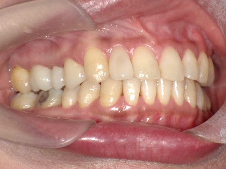 インビザラインの症例