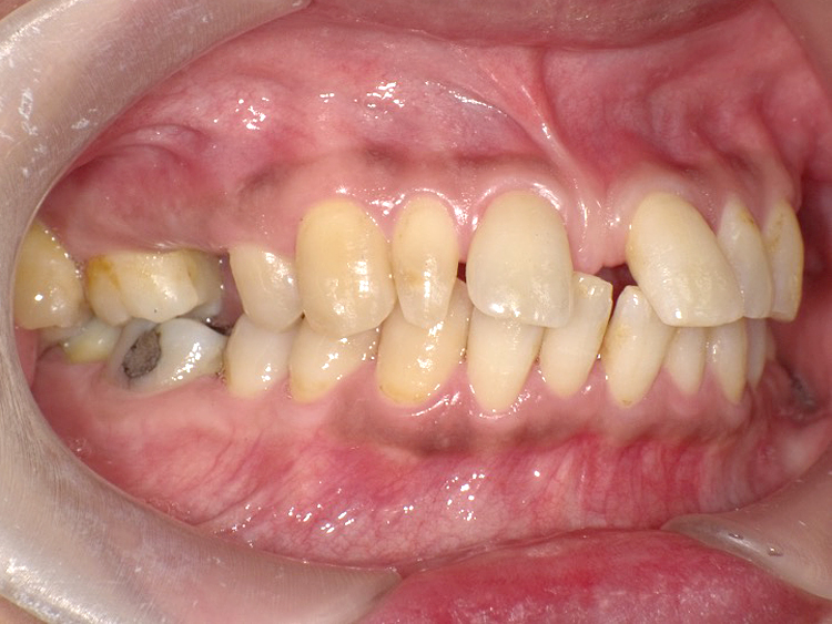 インビザラインの症例