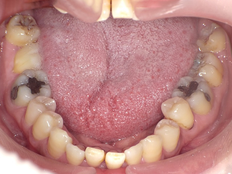 インビザラインの症例