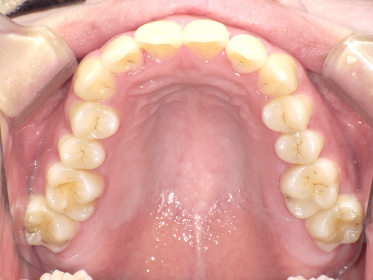 部分矯正の症例