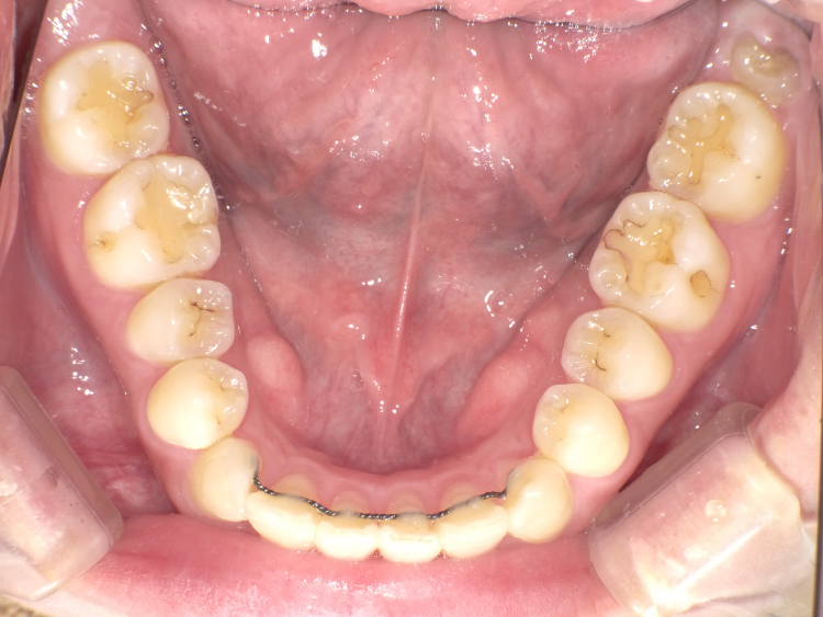 部分矯正の症例