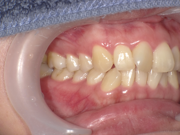 部分矯正の症例