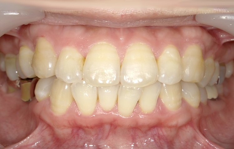 部分矯正の症例写真