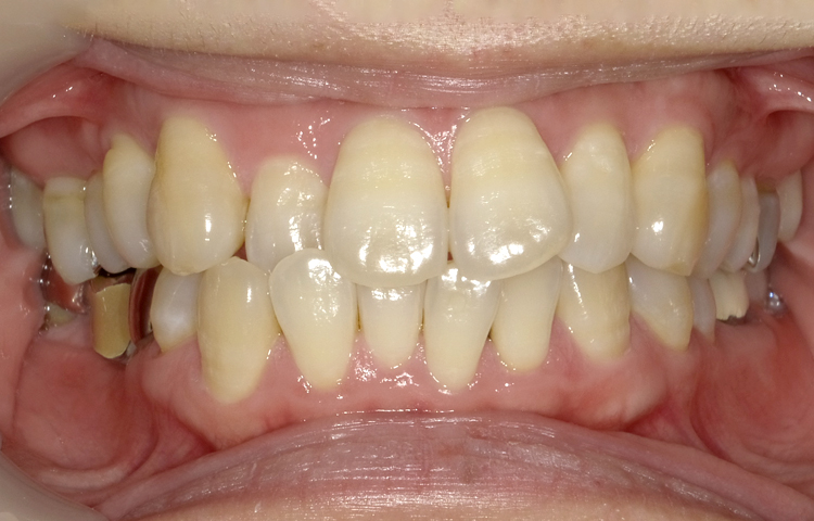 部分矯正の症例写真