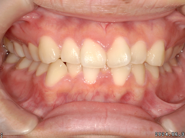 部分矯正の症例