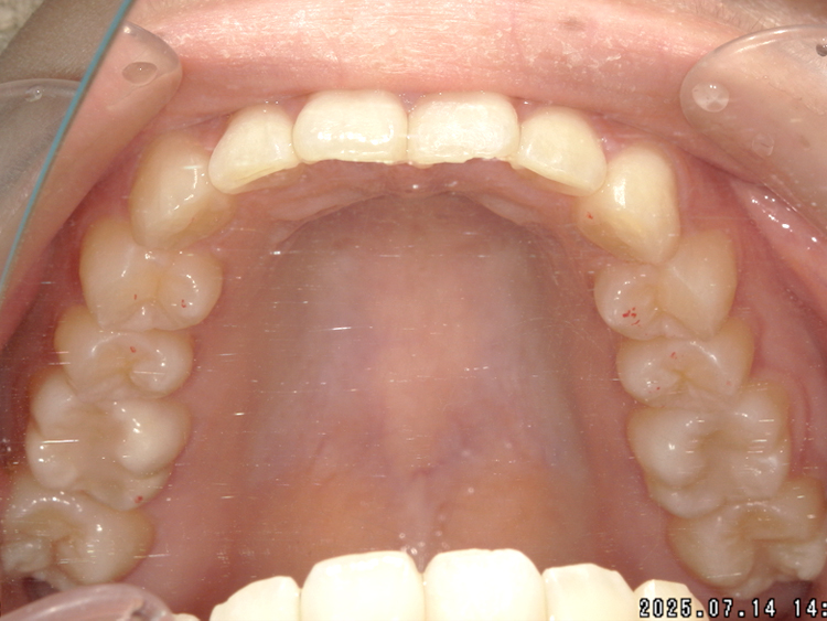 部分矯正の症例