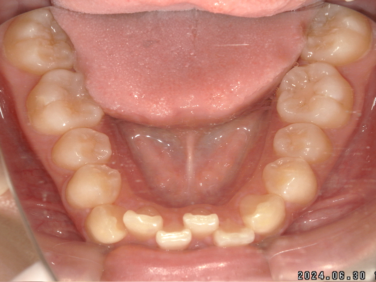 部分矯正の症例