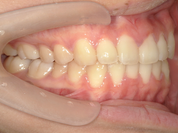 部分矯正の症例