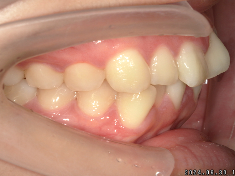 部分矯正の症例