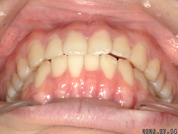 部分矯正の症例