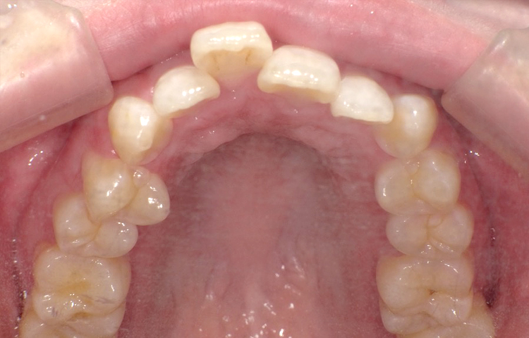 部分矯正の症例写真