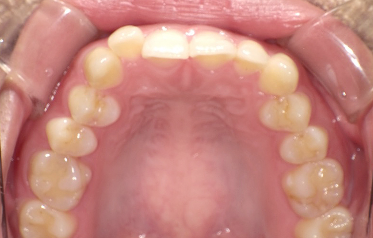 部分矯正の症例写真