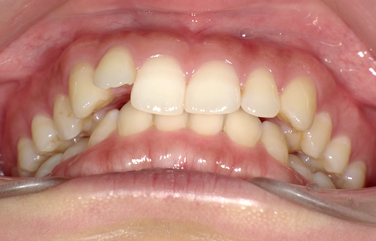 部分矯正の症例写真