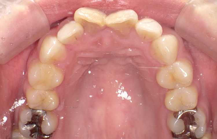 部分矯正の症例