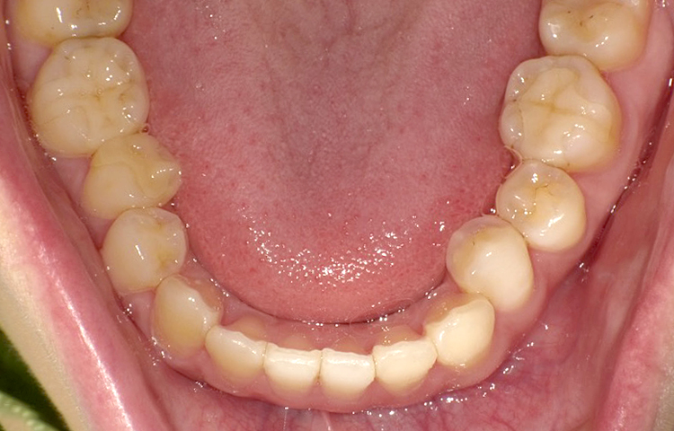 部分矯正の症例