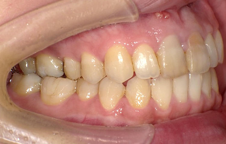 部分矯正の症例