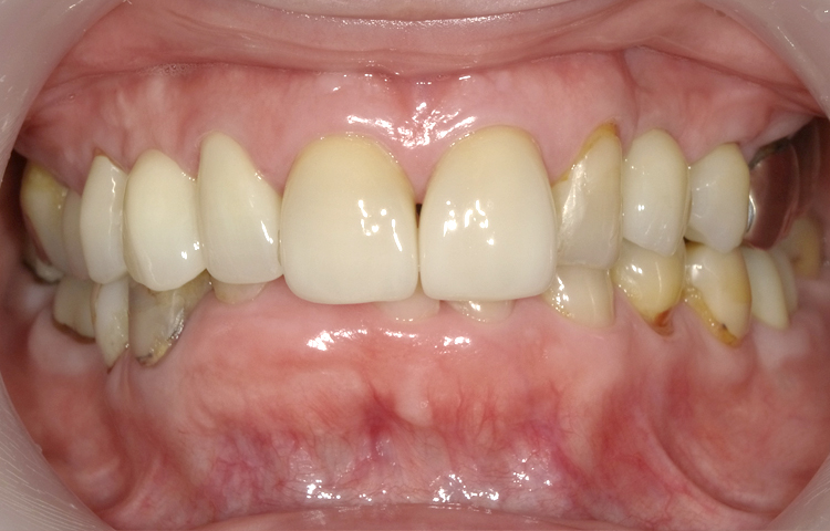 審美治療の症例写真