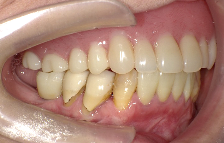 審美歯科の症例