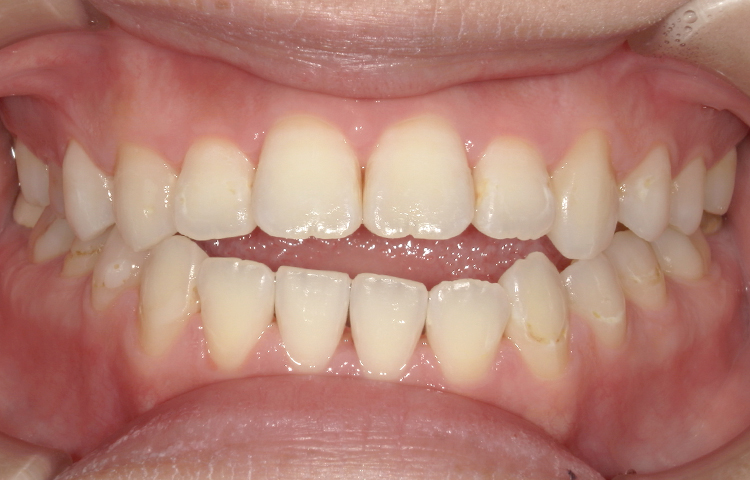 ホワイトニングの症例写真