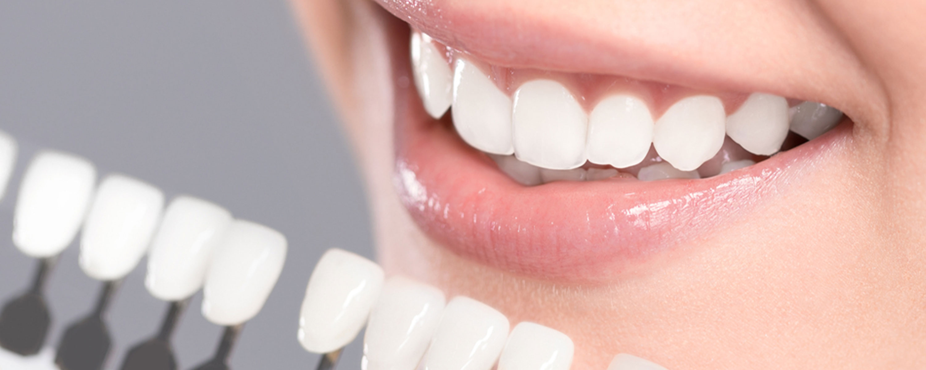 オフィスホワイトニング